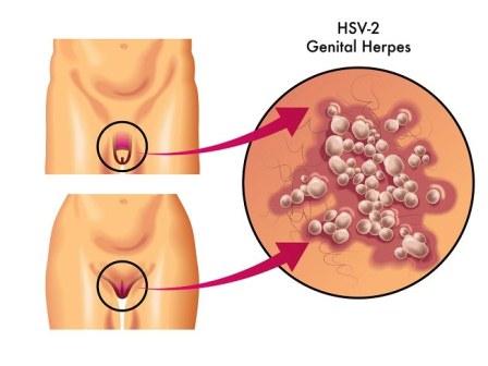 Penyakit Herpes Genitalis pada Kelamin Pria dan Wanita 2023